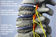 Pincement Discal