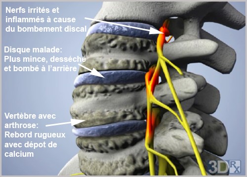 Pincement Discal